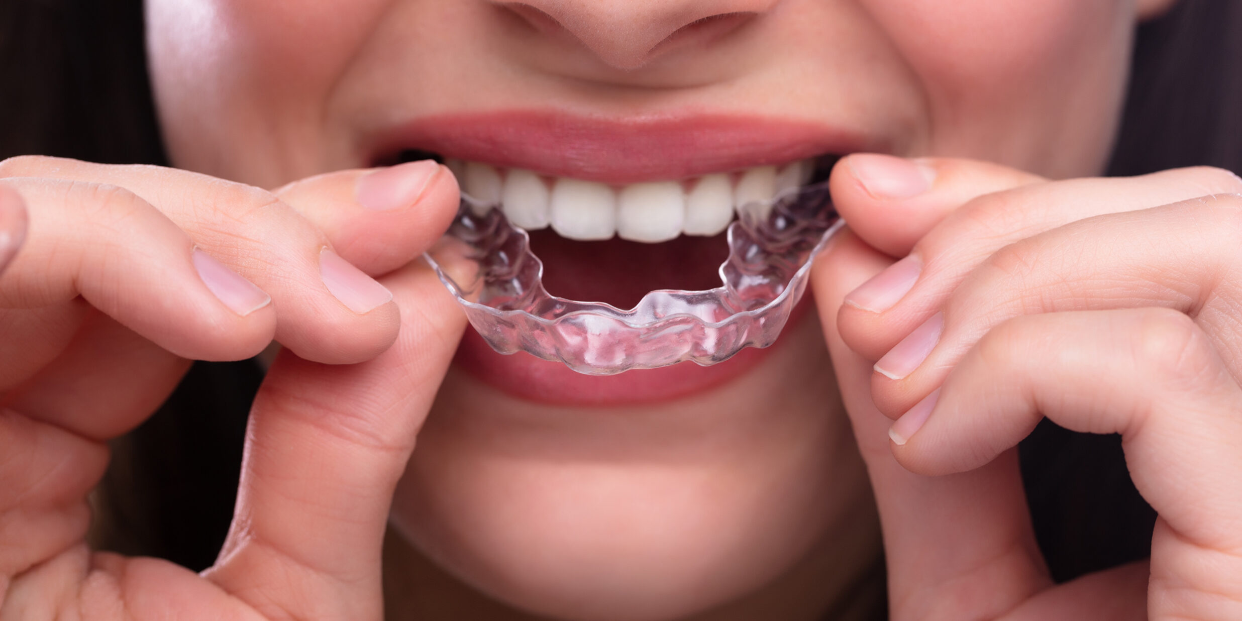 férula de descarga para bruxismo