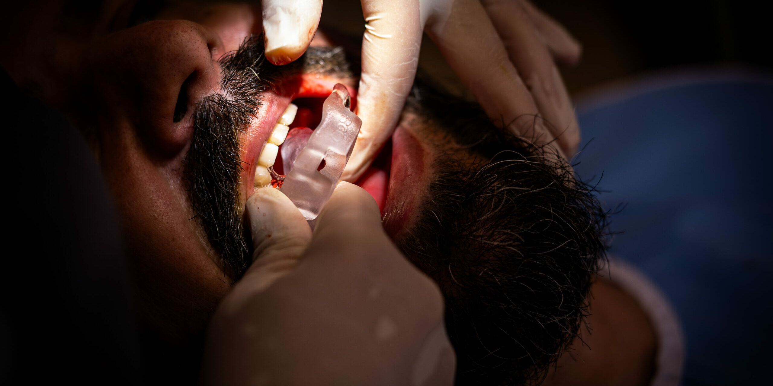 Sin título-02 Implantes de una sola pieza en casos con poco hueso