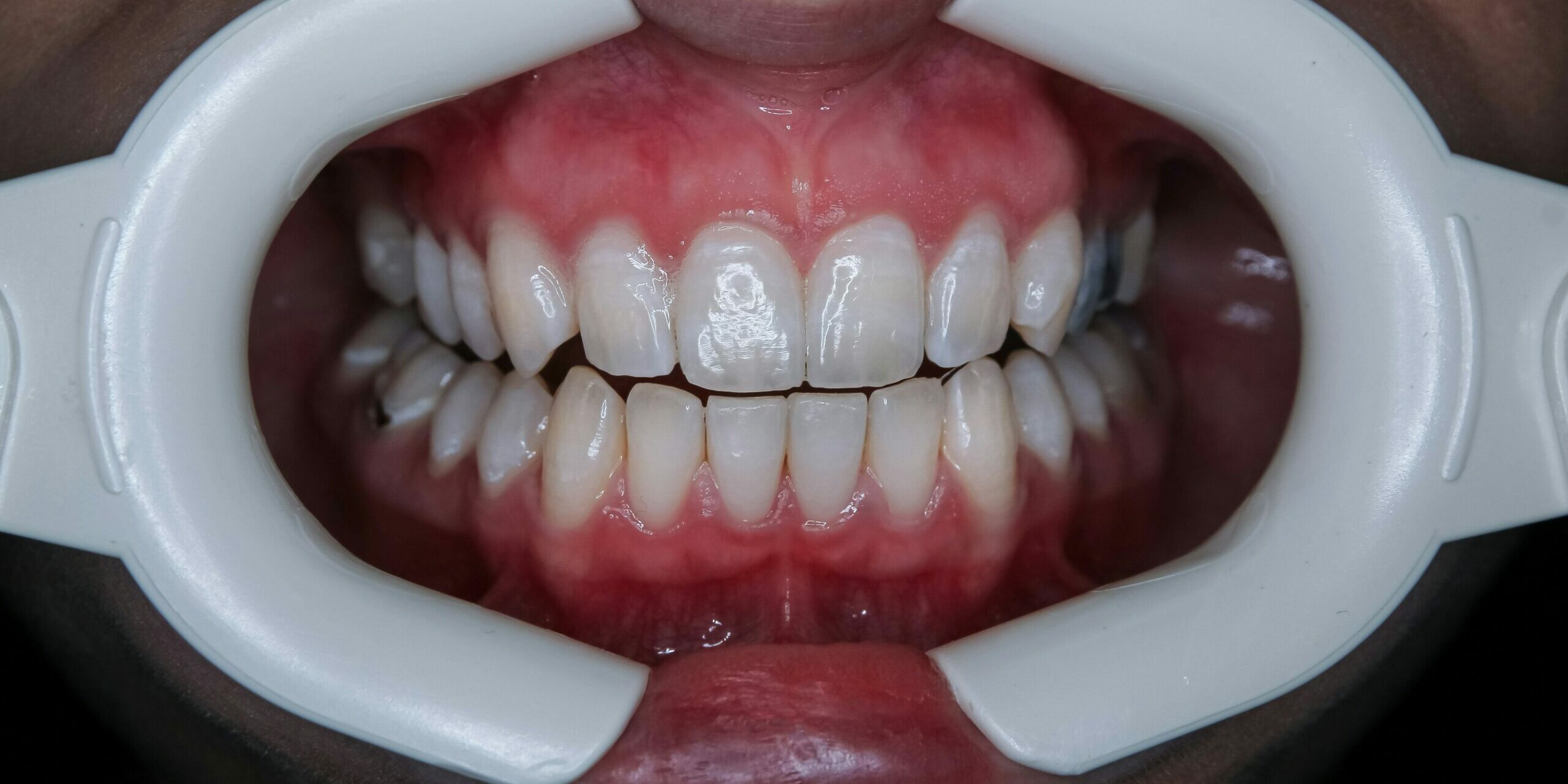 Estética dental en Ciudad Real: mejora tu sonrisa sin complejos