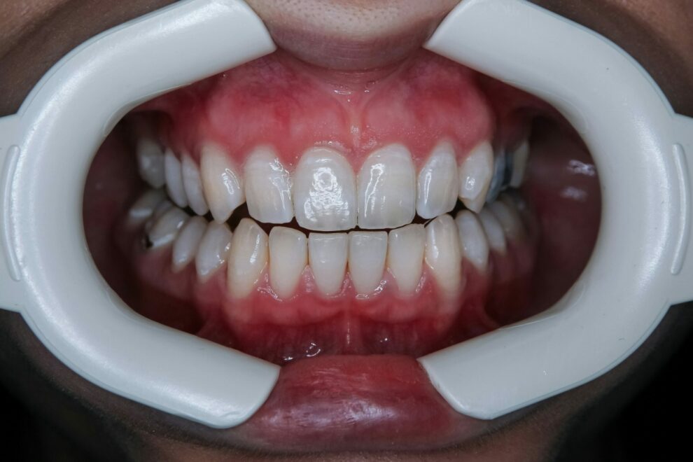 Estética dental en Ciudad Real: mejora tu sonrisa sin complejos Estética dental en Ciudad Real: mejora tu sonrisa sin complejos