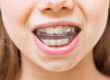 Invisalign en niños: cuándo empezar y tratamiento precoz