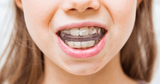 Invisalign en niños: cuándo empezar y tratamiento precoz