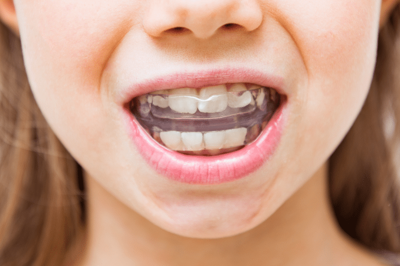 Invisalign en niños: cuándo empezar y tratamiento precoz