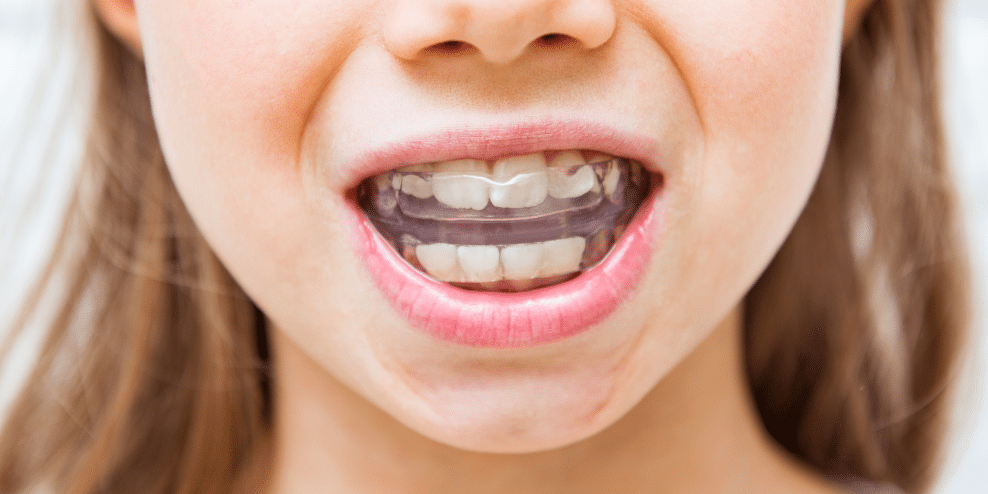 Invisalign en niños: cuándo empezar y tratamiento precoz