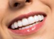 Invisalign en adultos en Ciudad Real. Ortodoncia invisible con planificación personalizada para mejorar estética y salud bucodental.