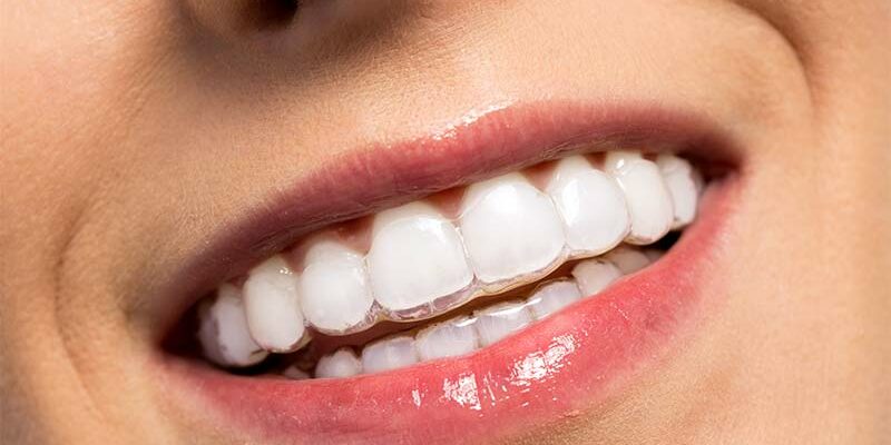 Invisalign en adultos en Ciudad Real. Ortodoncia invisible con planificación personalizada para mejorar estética y salud bucodental.
