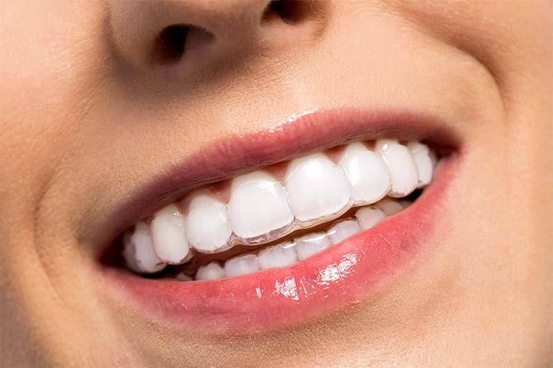 Invisalign en adultos en Ciudad Real. Ortodoncia invisible con planificación personalizada para mejorar estética y salud bucodental.