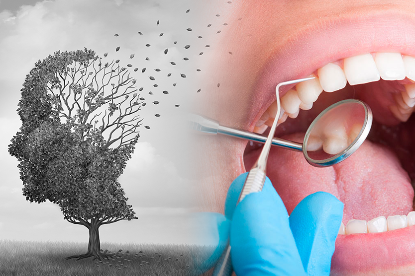 periodontitis y alzheimer