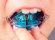 Ortopedia dental infantil: preparar la boca antes de la ortodoncia