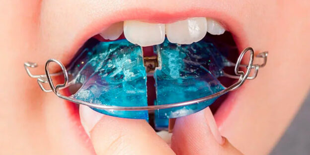 Ortopedia dental infantil: preparar la boca antes de la ortodoncia