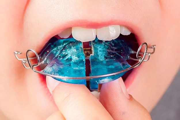 Ortopedia dental infantil: preparar la boca antes de la ortodoncia