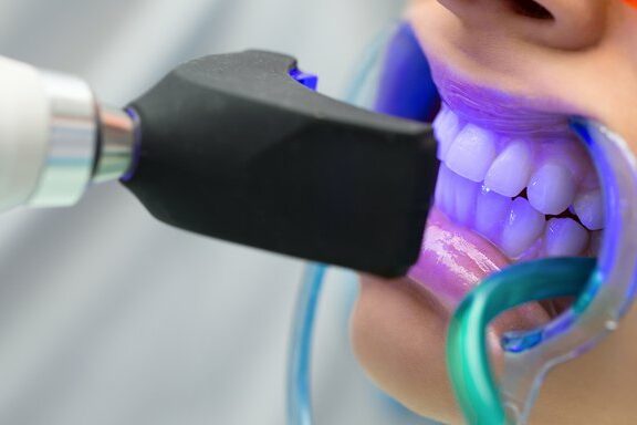 Blanqueamiento dental con tecnología avanzada