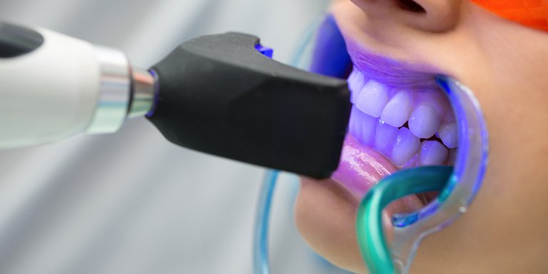 Blanqueamiento dental con tecnología avanzada