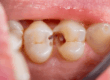 tipos-de-caries