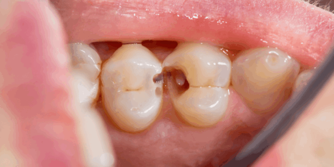 tipos-de-caries tipos-de-caries