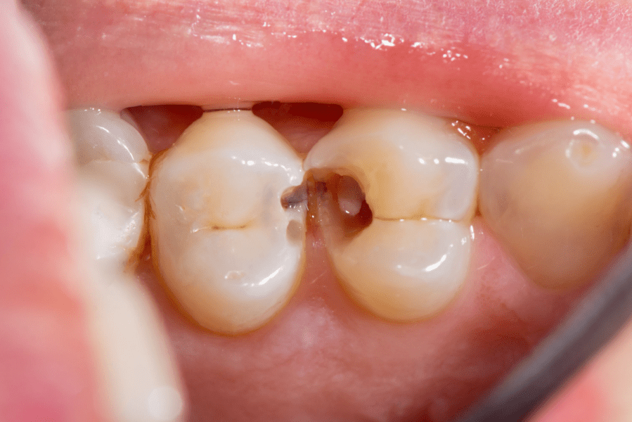 tipos-de-caries
