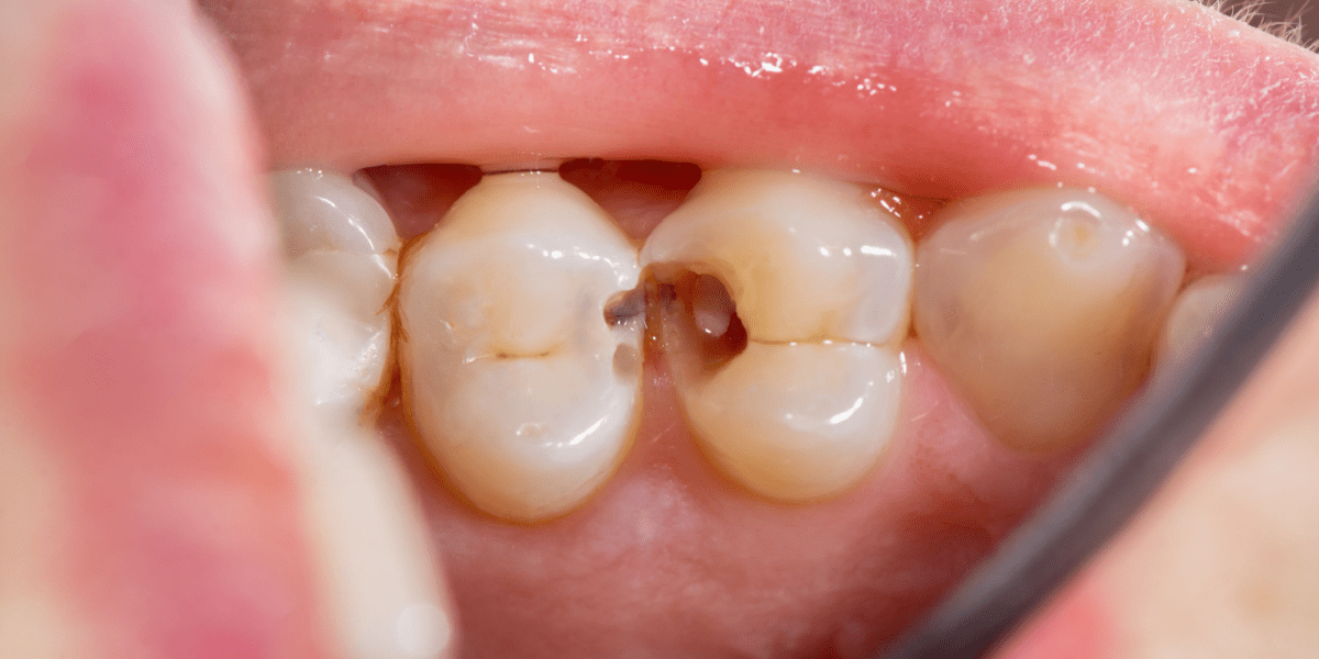 tipos-de-caries